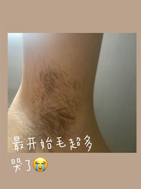 女生阴毛